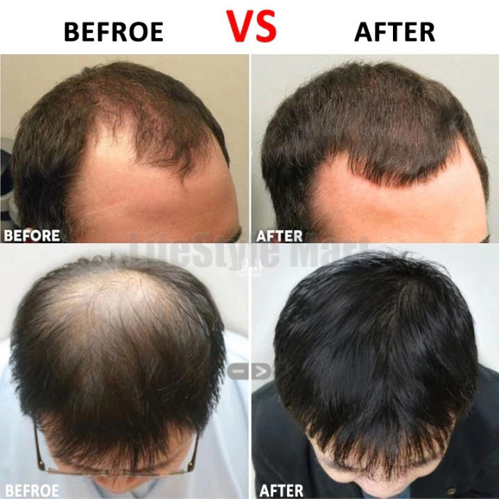 Facial%20Microneedle%20Derma%20Roller%20System%20Black%200.25mm%20-%20Image%205
