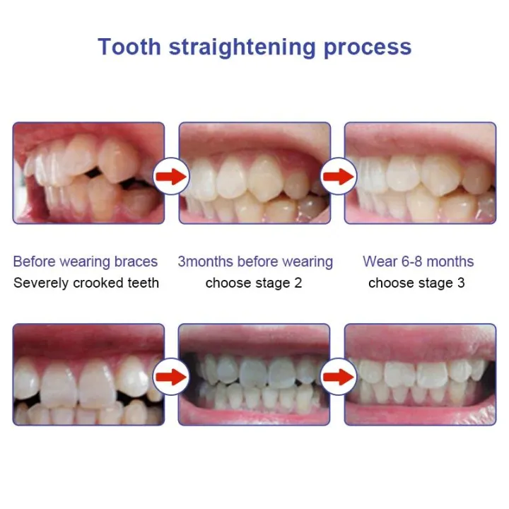 1/3PCS%20Teeth%20Corrector%20Tooth%20Orthodontic%20Trainer%20Braces%20Trainer%20for%20Teeth%20Alignment%203%20Phases%20for%20Adults%20Tooth%20Care%20Tools%20-%20Image%204