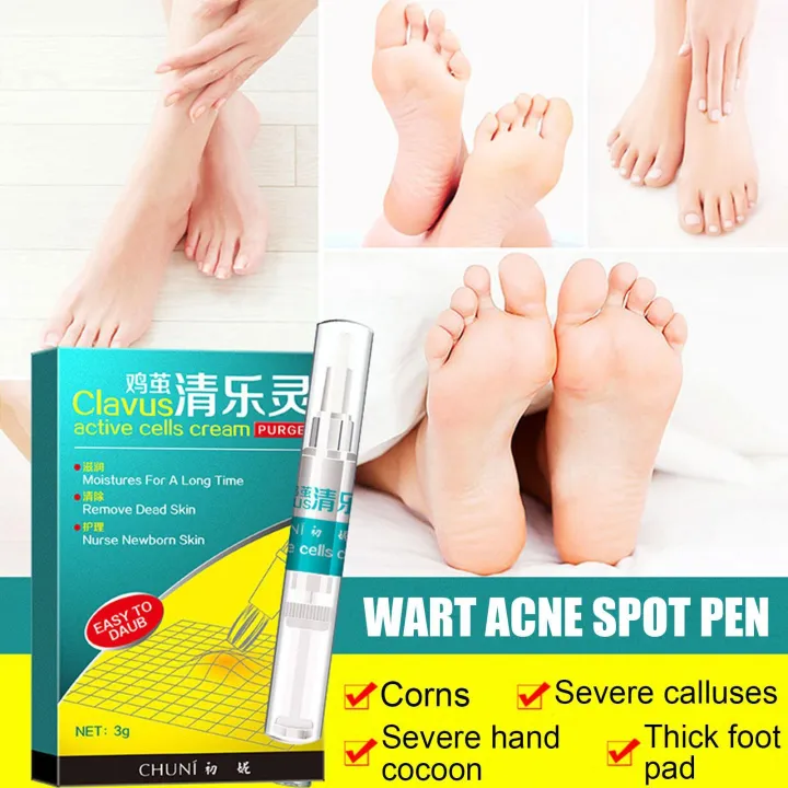 Foot%20Corn%20Removal%20Pen,%20Corn/callus%20Remover%20Liquid,%20Treatment%20Foot%20Genital%20Tag%20Care%20Skin%20Corn%20Skin%20Moles%20Remover%20Wart%20Remo%20G6x0%20-%20Image%203