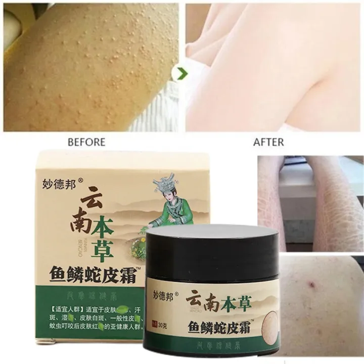 Coarse%20body%20hair,%20removal,%20cyst%20removal,%20Pila,%20good%20cream,%20keratosis,%20hairy%20chicken,%20skin%20condition,%20hole%20modification,%20dark%20spots,%20moisturizing,%20whitening,%20smooth%20skin%20care%20-%20Image%206