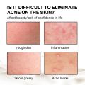 Anti Back Acne Soap Remove Pimple Oil Control Reduce Mite Anti Inflammation Deep Cleansing Acne Treatment Moisture Whiten Soap. 