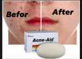 Stiefel Original Acne-Aid Bar 100g Pimple Prone & Oily Skin Acne Aid Soap. 