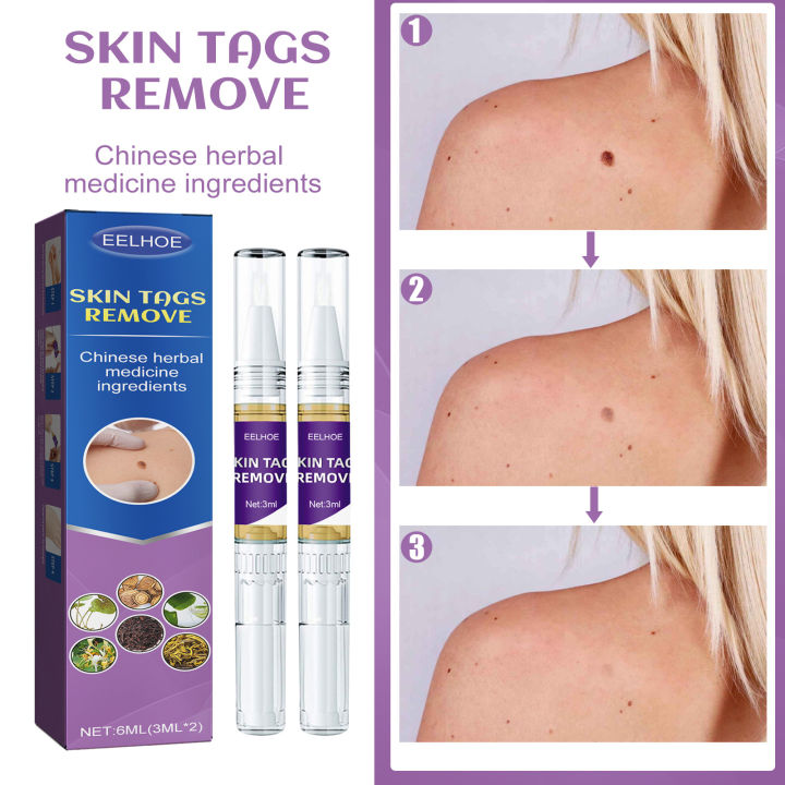 EELHOE%20Skin%20Care%20Gram%20Wart%20Liquid%20Desalination%20Nevus%20Pen%20Hand,%20Foot,%20Face%20And%20Neck%20Flesh%20Grain%20Skin%20Tag%20Removal%20Pen%20-%20Image%204