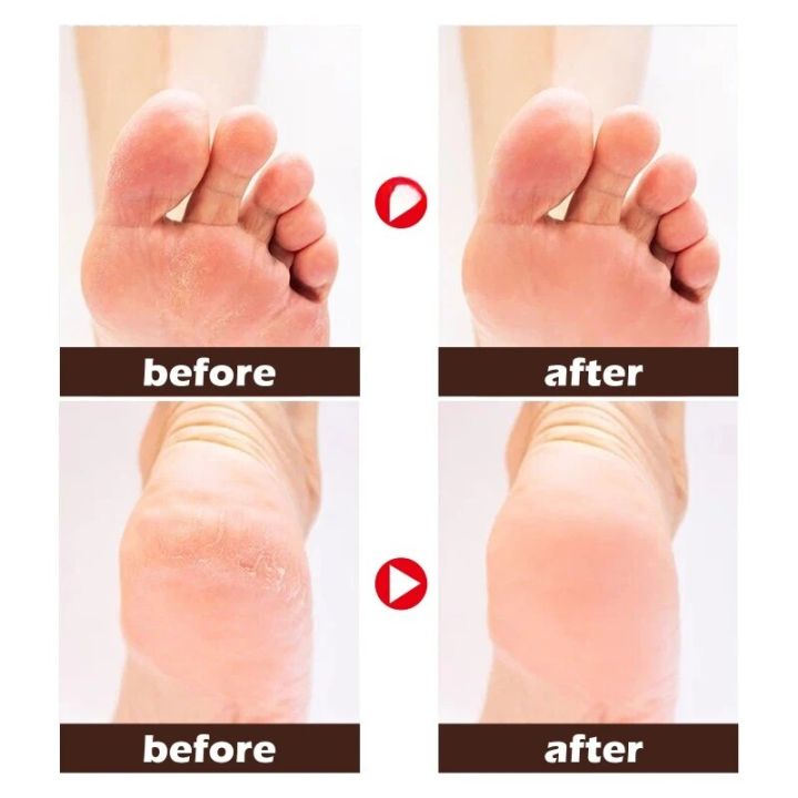 foot%20cream%20repair%20dry%20cracked%20heel%20peeling%20remove%20callus%20Dead%20skin%20exfoliating%20feet%20skin%20hydrating%20nourishing%20care%20-%20Image%202