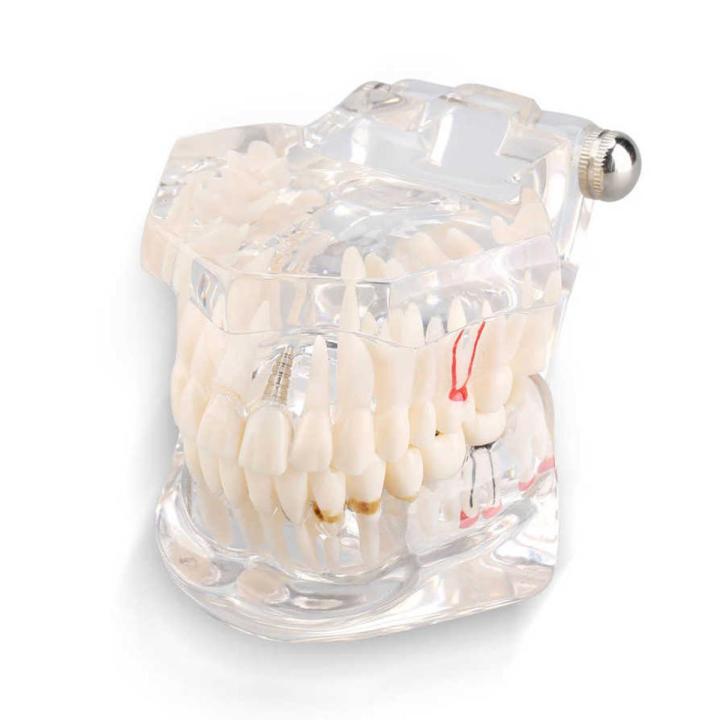 Dental Teaching Model Typodont | Teeth Implant & Pathology Study | Pink Gum M2001 - View #8