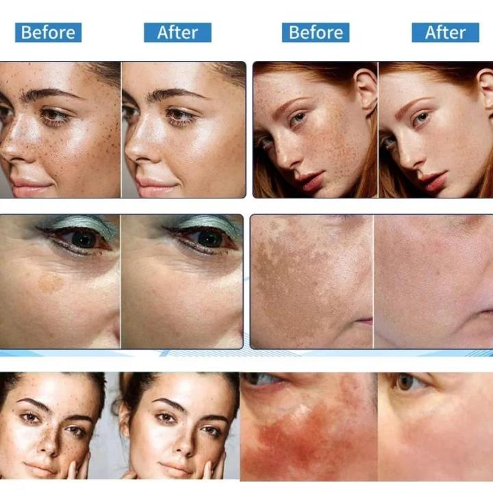 Chinese%20Astragalus%20Whitening%20Freckles%20Cream%20Remove%20Melasma%20Fade%20Dark%20Spots%20Dark%20Yellow%20Skin%20Brighten%20Anti-aging%20Face%20Skin%20Care%20-%20Image%202