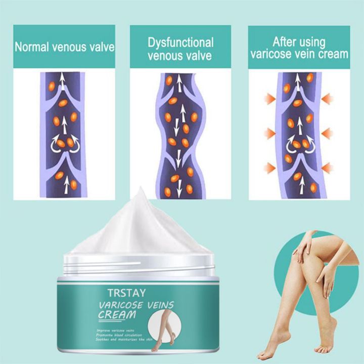Varicocele%20Cream%20Relieving%20Limb%20Swelling,%20Soothing,%20and%20Moisturizing%20Skin%20-%20Image%203