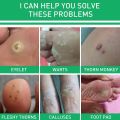 Effective Foot Corn Remover Care Remove Foot Calluses Remove Warts Smooth Skin Mild Wart Remover Corns Foot Care Liquid Solution. 