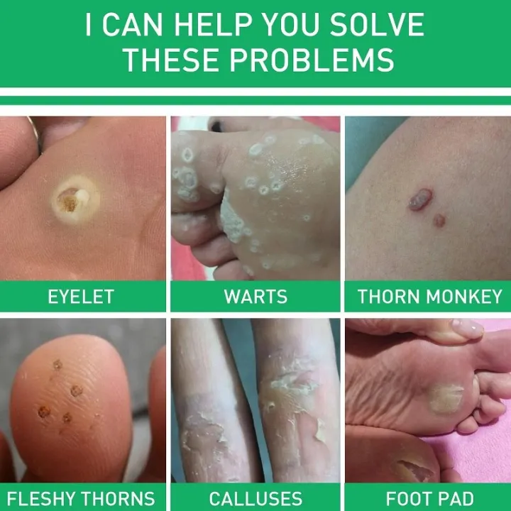 Effective%20Foot%20Corn%20Remover%20Care%20Remove%20Foot%20Calluses%20Remove%20Warts%20Smooth%20Skin%20Mild%20Wart%20Remover%20Corns%20Foot%20Care%20Liquid%20Solution%20-%20Image%203