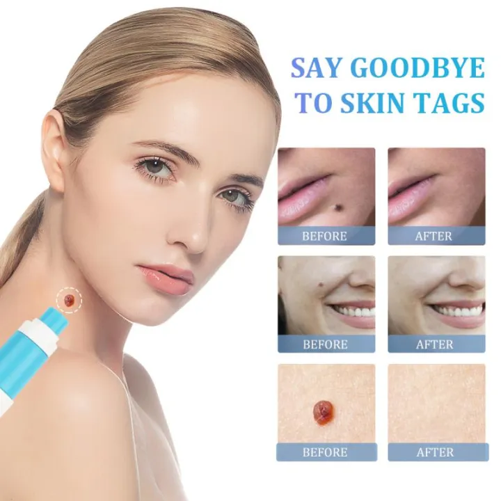 2-IN-1%20Auto%20Skin%20Tag%20Removal%20Kit%20Painless%20Skin%20Label%20Mole%20Acne%20Wart%20Removal%20Pen%20Set%20with%20Cleansing%20Swabs%20Facial%20Beauty%20Care%20Tool%20-%20Image%204