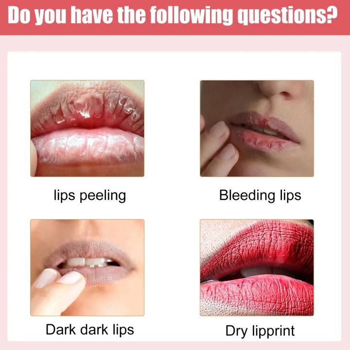 Lip%20Lightening%20Dark%20Lips%20Bleach%20Lips%20Whiten%20Remove%20Dull%20Black%20Lip%20Deep%20Nourish%20Fade%20Lip%20Lines%20Moisturize%20Bright%20-%20Image%205