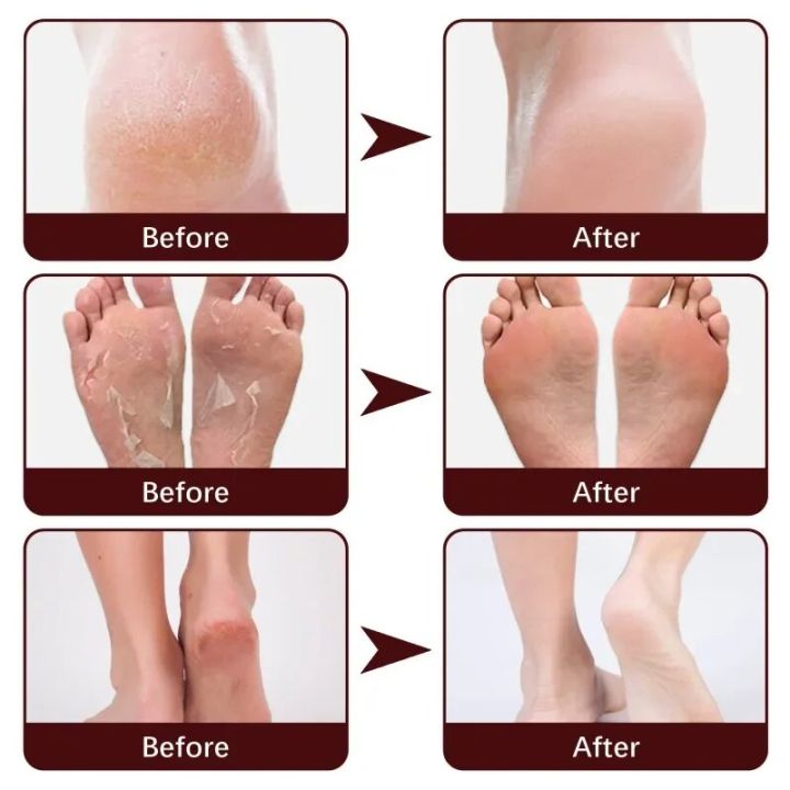Foot%20Massage%20Exfoliating%20Cream%20Heels%20Anti-Drying%20Peeling%20Cracked%20Feet%20Care%20Moisturizing%20Exfoliation%20remove%20Dead%20Skin%20Foot%20Cream%20-%20Image%204