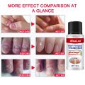 Nail Fungus Treatment 7 Day Repair Potion Essence Anti Infective Onychomycosis Nail Fungus Removal Gel Foot Care. 