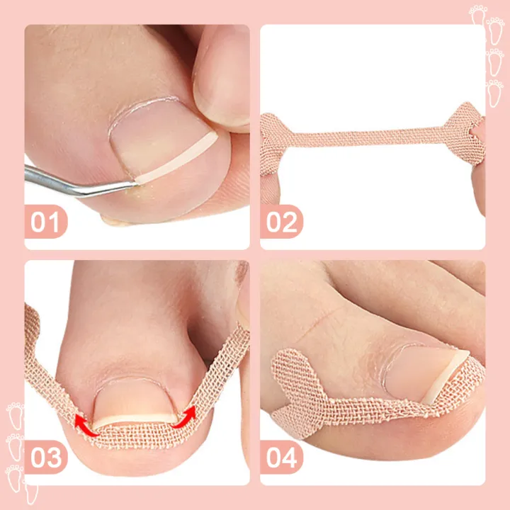 8%20Pack%20Ingrown%20Toenail%20Corrector%20Sticker%20Paronychia%20Treatment%20Fixer%20Restoration%20Pedicure%20Elastic%20Sticker%20Foot%20Toe%20Nail%20Care%20Tool%20-%20Image%207
