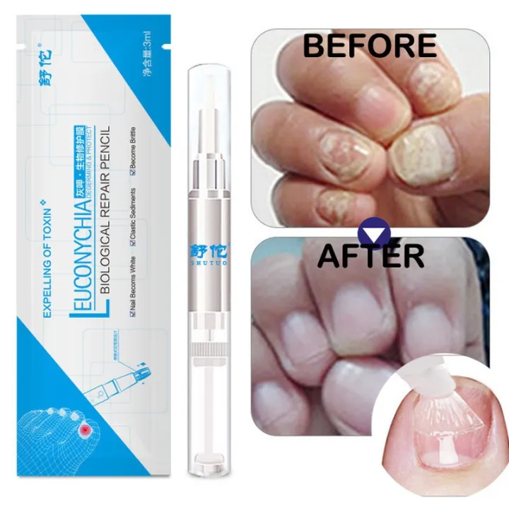 Gentle%20ingredients%20skin%20friendly%20and%20no%20side%20effect%203ML%20Fungal%20Nail%20Treatment%20Pen%20Onychomycosis%20Paronychia%20Anti%20Fungal%20Nail%20Infection%20Chinese%20Herbal%20-%20Image%204