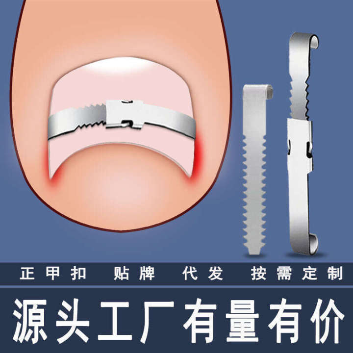 Straight buckle straight sticker prick pulling patch toenail growing ...