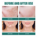 Melasma Removal Cream Niacinamide Brightening Reduce Melanin Facial Cream Lighten Dark Skin Shrink Pores Moisturizer Skin Care. 