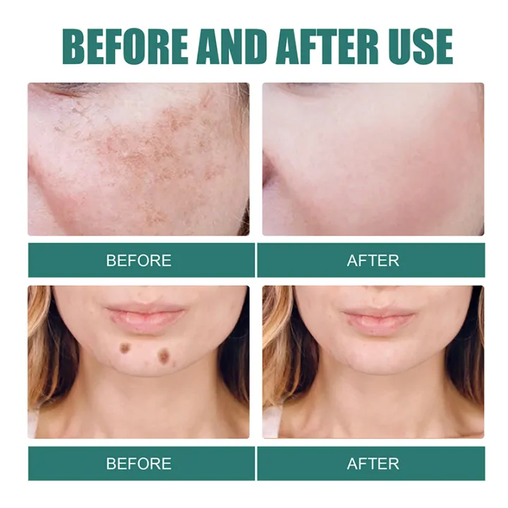 Melasma%20Removal%20Cream%20Niacinamide%20Brightening%20Reduce%20Melanin%20Facial%20Cream%20Lighten%20Dark%20Skin%20Shrink%20Pores%20Moisturizer%20Skin%20Care%20-%20Image%204