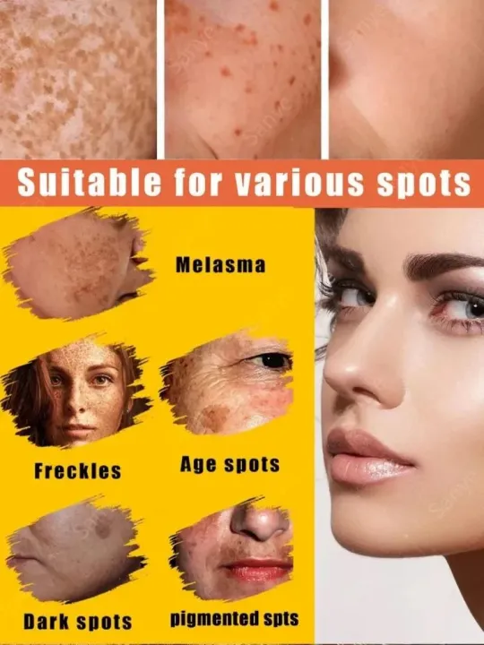 Face%20Chloasma%20Removal%20Cream%20For%20Women%20Remove%20Melasma%20Brighten%20Cream%20Facial%20Fade%20Dull%20Brightening%20Cream%20Dark%20Skin%20Lightening%20Care%20-%20Image%202
