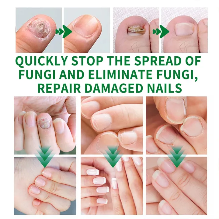 EELHOE%20Makes%20Your%20Nail%20Clean%20EELHOE%20Nail%20Repair%20Serum%20Nail%20Repair%20Oil%2015ML%20-%20Image%206