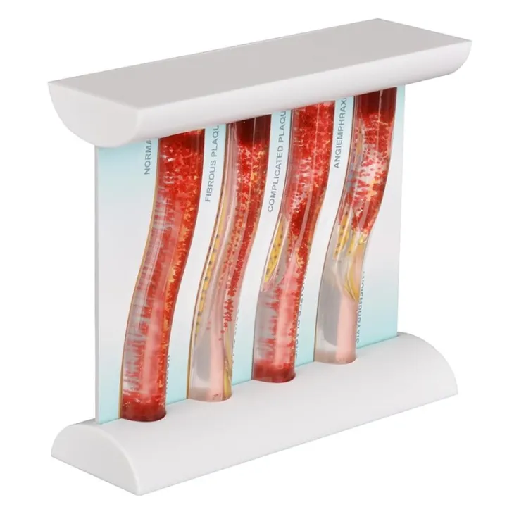 LDL%20Cholesterol%20Blood%20Vessel%20Model,%204-Stage%20Vascular%20Disease%20Teaching%20and%20Training%20Tool%20-%20Image%204