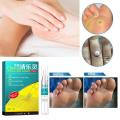 Foot Corn Removal Pen, Corn/callus Remover Liquid, Treatment Foot Genital Tag Care Skin Corn Skin Moles Remover Wart Remo G6x0.