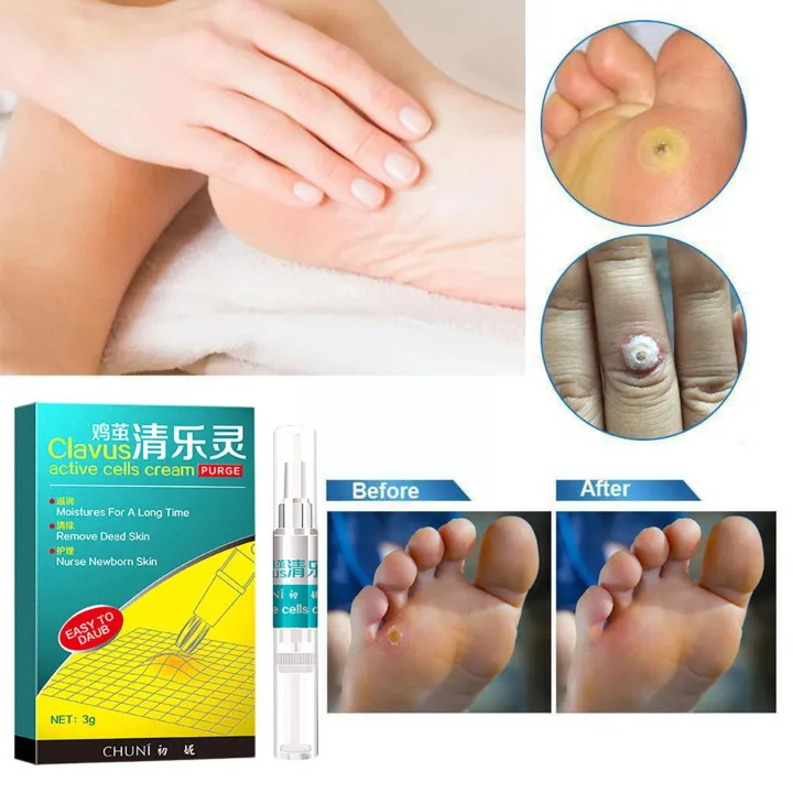 Foot%20Corn%20Removal%20Pen,%20Corn/callus%20Remover%20Liquid,%20Treatment%20Foot%20Genital%20Tag%20Care%20Skin%20Corn%20Skin%20Moles%20Remover%20Wart%20Remo%20G6x0%20-%20Image%204