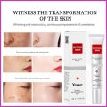 YOUBUY Whitening Freckle Cream Remove Dark Spots Anti Freckle Cream Niacinamide Fade Pigmentation Melasma Brighten. 
