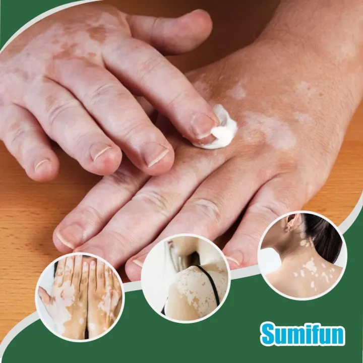Sumifun%20Vitiligo%20Care%20Cream,%20Vitiligo%20Treatment,%20Reduces%20White%20Spots%20on%20Skin,%20Pigmentation%20regulating%2020G%20-%20Image%203