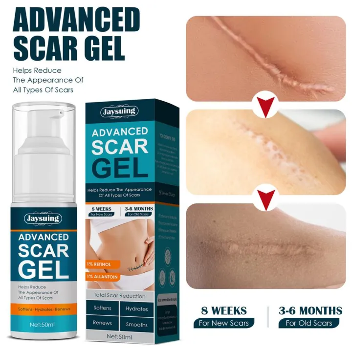 50ml%20Scar%20Removal%20Gel%20-%20Effective%20Stretch%20Mark,%20Acnes%20Spots,%20Burns%20and%20Surgical%20Scars%20Treatment%20Cream%20-%20Retinol,%20Allantoin,Vitamin%20E%20-%20Post%20Surgery%20Skin%20Repair%20Supplies%20No%20Side%20Effects%20-%20Image%204