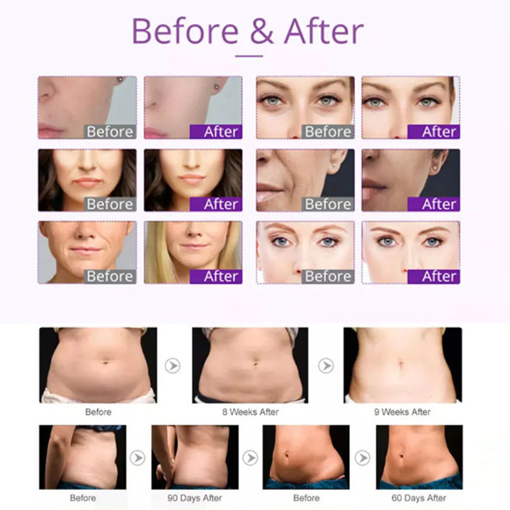 40K%20Ultrasonic%20Cavitation%20Lipo%20Slimming%20Vacuum%20Radiofrequency%20Body%20Slimming%20Beauty%20Machine%20Shaping%20Massage%20Equipment%20For%20Spa%20-%20Image%206