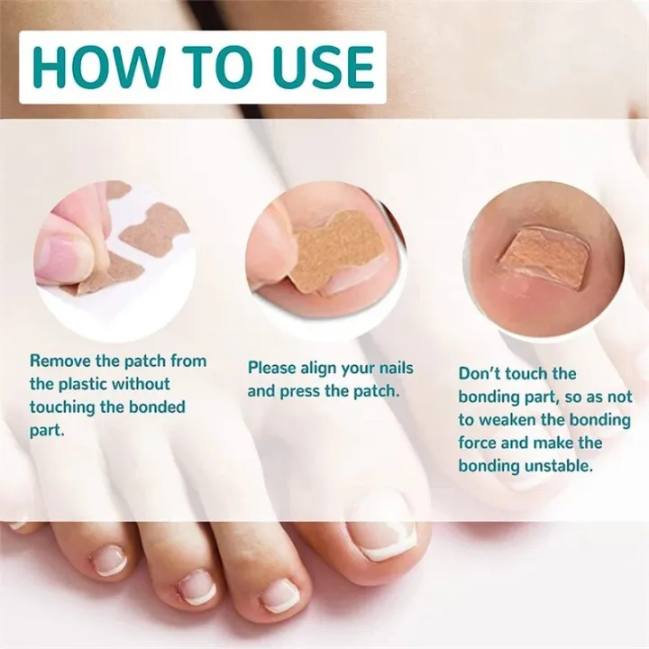 Pexmen%2010/20/50/100Pcs%20Ingrown%20Toenail%20Correction%20Stickers%20Toenail%20Corrector%20Patch%20Keep%20Nails%20Healthy%20Relieve%20Pain%20-%20Image%204