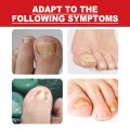 South Moon Inner Toenail Repair Serum, Nail Repair Nail Care, Nail Care, Essential Oils, Cleanse and Remove Nail Fungus. 