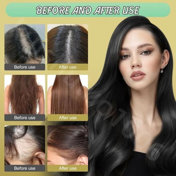 Ginger%20Plant%20Extract%20Anti-Hair%20Loss%20Hair%20Shampoo%20Ginger%20Extract%20From%20Japan%20Polygonum%20Multiflorum%20Oil%20Control%20Anti-Dandruff%20240ML%20-%20Image%202