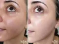 Beaute Melasma-X Glutathione Brightening Tone Up Cream 45ml. 