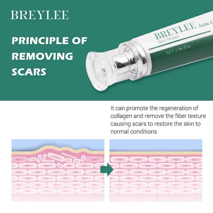 Breylee%20Skin%20Repair%20Acne%20Cream%20-%2030g%20-%20Image%204