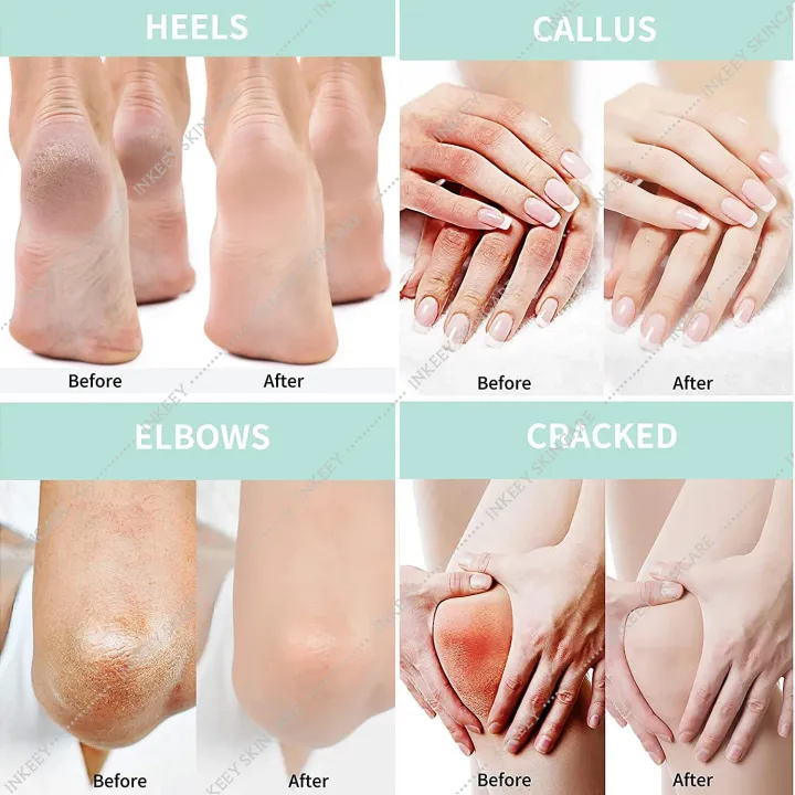 Urea%2040%25%20Cream%20for%20Dry%20Cracked%20Feet%20Heels%20Hands%20Body%20Repairing%20Treatment%20Deeply%20Moisturizing%20Callus%20Dead%20Skin%20Remove%20Foot%20Care%20-%20Image%203