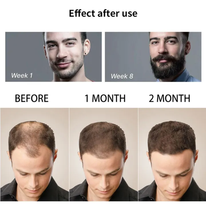 DRS%20540%20Beard%20Derma%20Roller%20Titanium%20for%20Hair%20Growth%20Mesoroller%20Face%20Machine%20Skin%20Care%20Microniddle%20Needle%20Roller%20Microneedling%20-%20Image%204