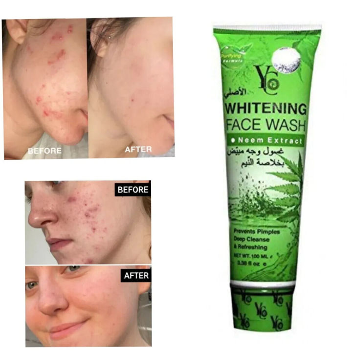 YC%20Whitening%20Neem%20Extract%20Acne%20Face%20Wash%20for%20Unisex%20-%20Prevent%20Pimples%20deep%20cleanse%20&%20Refreshing%20(100%20ML)%20-%20Image%202