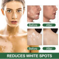 Sumifun Vitiligo Cream Reduces White Spots and Improves Skin Pigmentation 20gm.