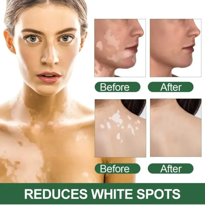 Sumifun%20Vitiligo%20Cream%20Reduces%20White%20Spots%20and%20Improves%20Skin%20Pigmentation%2020gm%20-%20Image%204