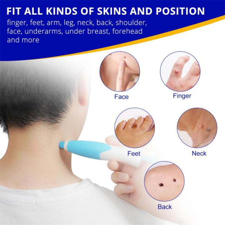 2%20In1%20Painless%20Auto%20Skin%20Tag%20Mole%20Wart%20Removal%20Kit%20Cleaning%20Tools%20Face%20Skin%20Care%20Body%20Wart%20Dot%20Treatments%20Remover%20Beauty%20Health%20Vnce%20Lncei%20-%20Image%202