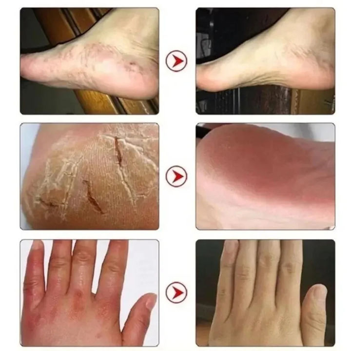 EELHOE%20Anti%20Crack%20Foot%20Hand%20Gel%20Ginger%20%20Cuticles%20Care%20Anti-Drying%20Healing%20Crack%20Frost%20Mask%20Dead%20Skin%20Removal%20Deep%20Moisturizing%20Feet%20Crack%20Whitening%20Smooth%20Feet%20Care%20-%20Image%206