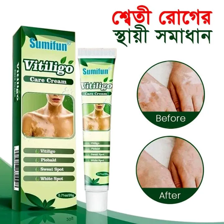 Sumifun%20Vitiligo%20Cream%20Reduces%20White%20Spots%20and%20Improves%20Skin%20Pigmentation%2020gm%20-%20Image%206