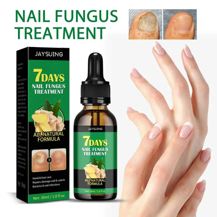 7DAYS%20Repair%20Nail%20Fungus%20Treatments%20Essence%20Foot%20Care%20Serum%20Toe%20Nails%20Fungal%20Removal%20Gel%20Anti-Infection%20Onychomycosis%20Care%20Tool%20-%20Image%202