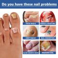 Fungus Nail Serum Repair Toenail Fungal Treatment Essence Anti Infection Drops Paronychia Remove Cuticle Oil Feet Nail Care 30ml. 