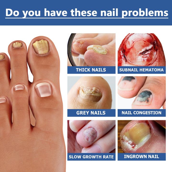 Fungus%20Nail%20Serum%20Repair%20Toenail%20Fungal%20Treatment%20Essence%20Anti%20Infection%20Drops%20Paronychia%20Remove%20Cuticle%20Oil%20Feet%20Nail%20Care%2030ml%20-%20Image%203