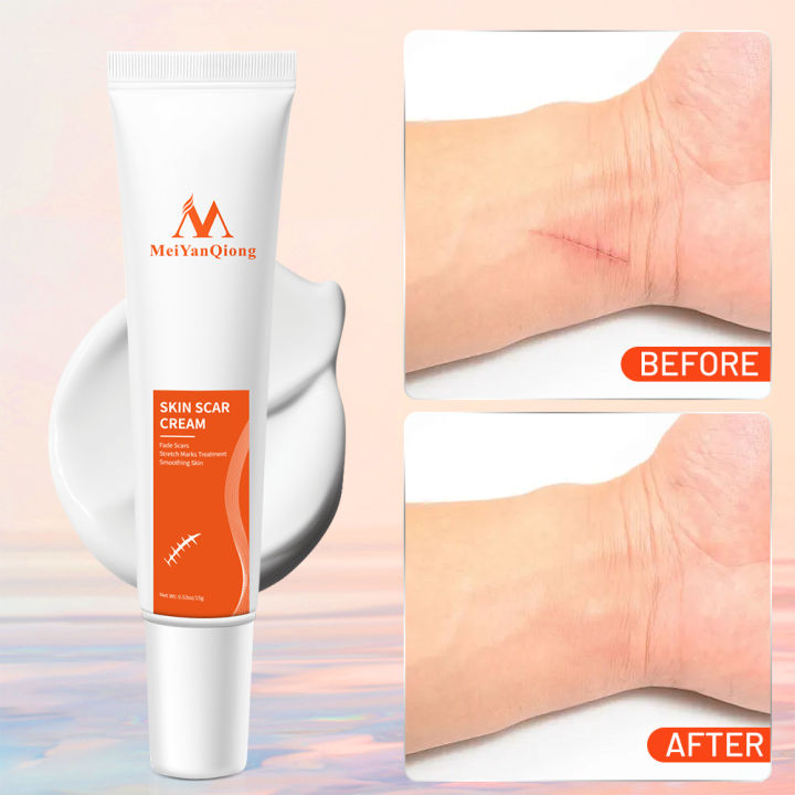 MeiYanQiong%20Acne%20Scar%20Remove%20Scar%20Cream%20Skin%20Repair%20Stretch%20Marks%20Keloid%20Remover%20Desalination%20Scar%20Face%20Cream%20Spots%20Effective%20Treatment%2015g%20-%20Image%203