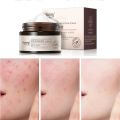 Remove Melasma Azelaic Acid 20% Whitening Fades Acne Cream Freckle Dark Pigment Spots Melanin Alpha Arbutin Face Cream Skin Care. 