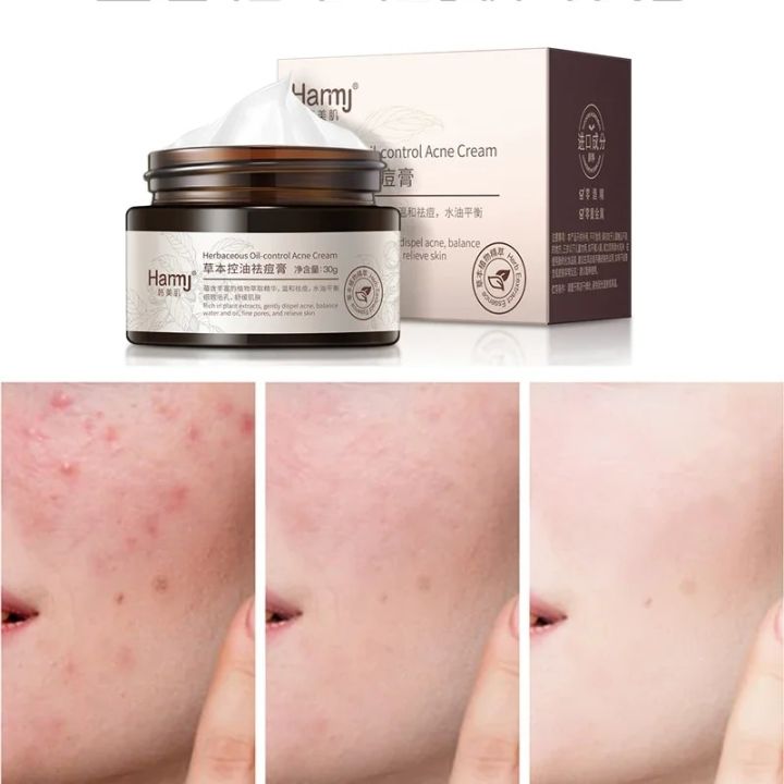 Remove%20Melasma%20Azelaic%20Acid%2020%25%20Whitening%20Fades%20Acne%20Cream%20Freckle%20Dark%20Pigment%20Spots%20Melanin%20Alpha%20Arbutin%20Face%20Cream%20Skin%20Care%20-%20Image%202